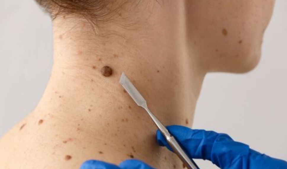 Prefeitura de Cáceres amplia atendimento dermatológico e reforça cuidado com a saúde da pele