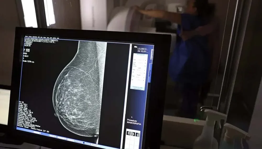 ANS defende que plano cubra mamografia digital sem restrição de idade