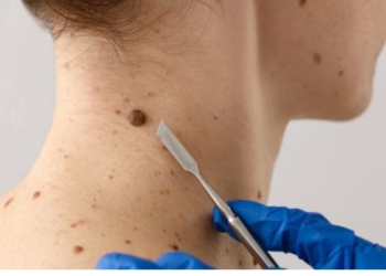 Prefeitura de Cáceres amplia atendimento dermatológico e realiza mutirão de pequenas cirurgias
