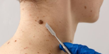Prefeitura de Cáceres amplia atendimento dermatológico e realiza mutirão de pequenas cirurgias