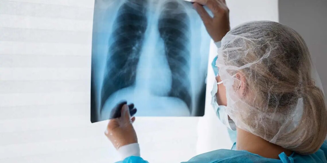 Diagnóstico tardio dá poucas chances de cura para o câncer de pulmão