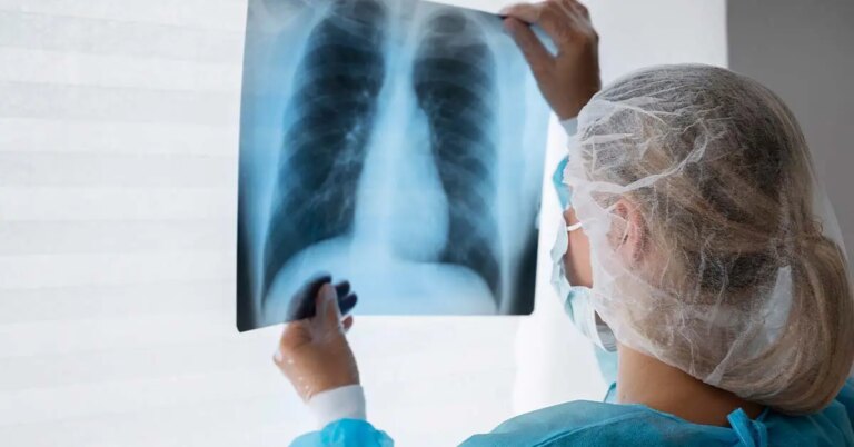 Diagnóstico tardio dá poucas chances de cura para o câncer de pulmão