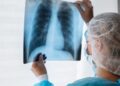 Diagnóstico tardio dá poucas chances de cura para o câncer de pulmão