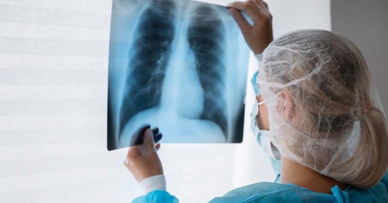 Diagnóstico tardio dá poucas chances de cura para o câncer de pulmão