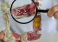 Em 13 anos, doença inflamatória intestinal cresce 5 vezes no Brasil