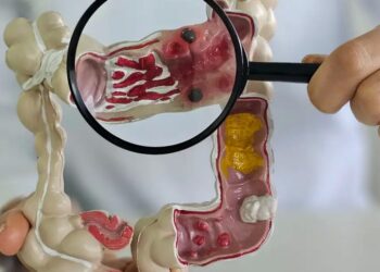 Em 13 anos, doença inflamatória intestinal cresce 5 vezes no Brasil