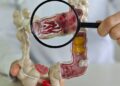 Em 13 anos, doença inflamatória intestinal cresce 5 vezes no Brasil