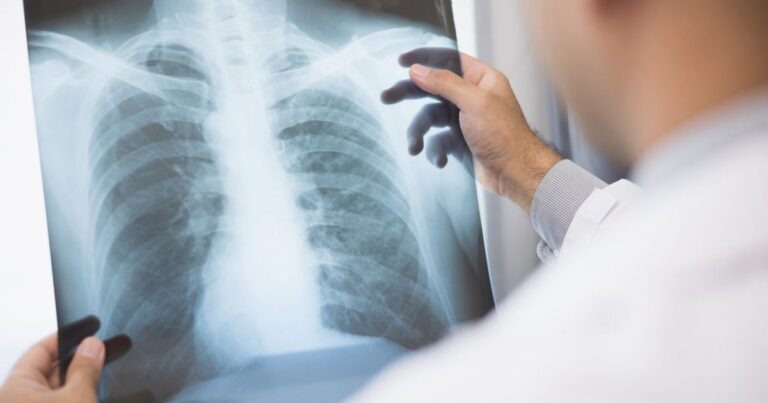 Anvisa aprova novo medicamento para câncer de pulmão avançado