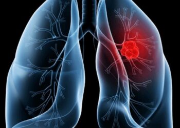 Saiba o que é adenocarcinoma pulmonar, câncer que atinge o Papa Leão